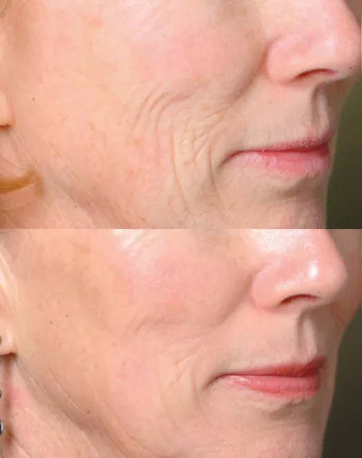 What is Recover After Micro Laser Peel