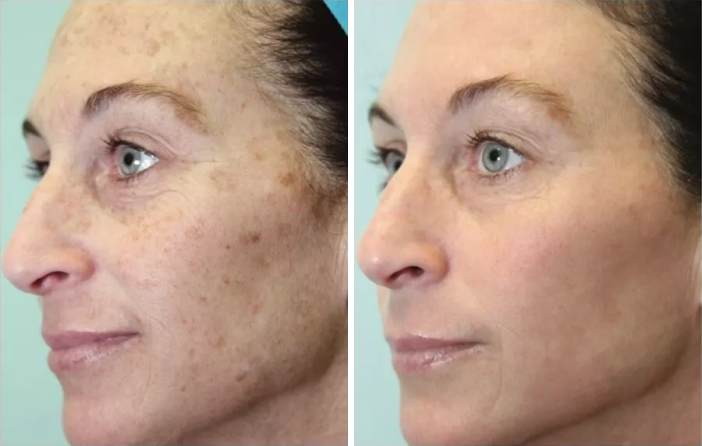 What is a Micro Laser Peel