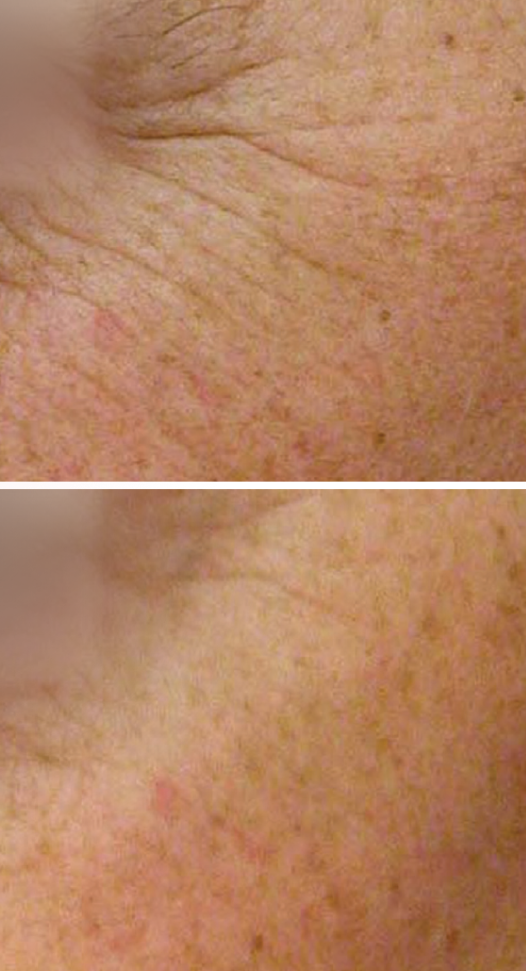 What Conditions Does the NanoLaser Peel Treat